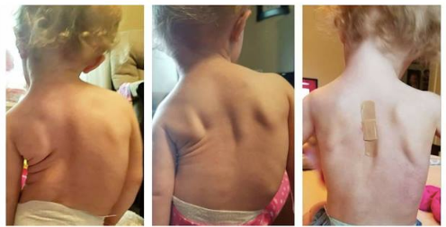 3 Prayers for Scoliosis – Hope for My Scoliosis